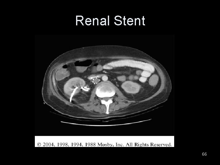 Renal Stent 66 