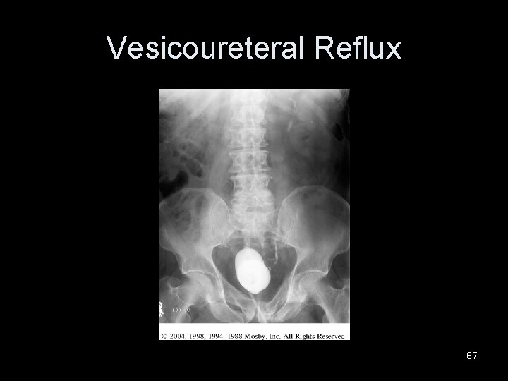 Vesicoureteral Reflux 67 