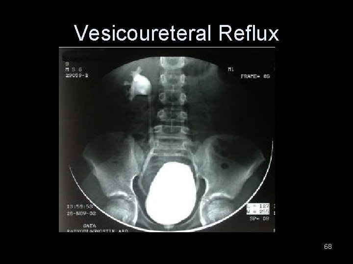 Vesicoureteral Reflux 68 