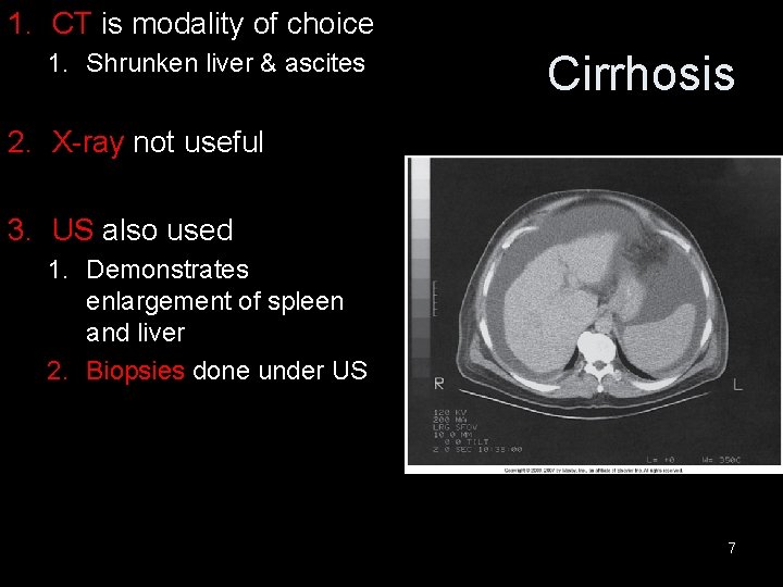 1. CT is modality of choice 1. Shrunken liver & ascites Cirrhosis 2. X-ray