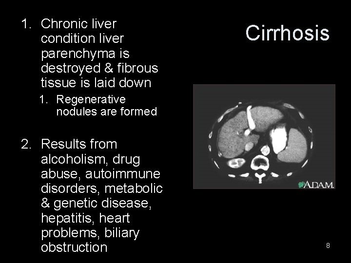 1. Chronic liver condition liver parenchyma is destroyed & fibrous tissue is laid down