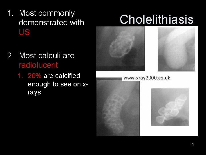 1. Most commonly demonstrated with US Cholelithiasis 2. Most calculi are radiolucent 1. 20%