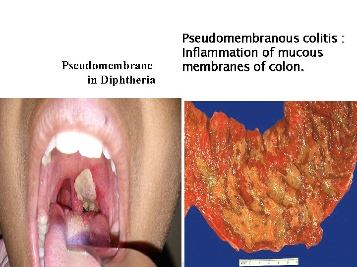Pseudomembrane in Diphtheria Pseudomembranous colitis : Inflammation of mucous membranes of colon. Pseudomembrane in Diphtheria Pseudomembranous colitis : Inflammation of mucous membranes of colon.
