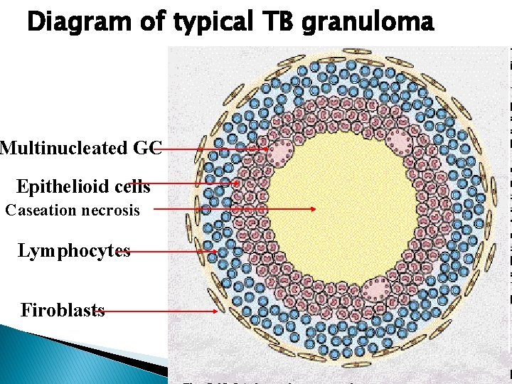 Diagram of typical TB granuloma Multinucleated GC Epithelioid cells Caseation necrosis Lymphocytes Firoblasts Diagram of typical TB granuloma Multinucleated GC Epithelioid cells Caseation necrosis Lymphocytes Firoblasts