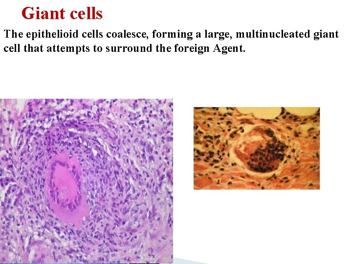 Giant cells The epithelioid cells coalesce, forming a large, multinucleated giant cell that attempts Giant cells The epithelioid cells coalesce, forming a large, multinucleated giant cell that attempts
