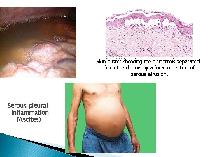 Skin blister showing the epidermis separated from the dermis by a focal collection of Skin blister showing the epidermis separated from the dermis by a focal collection of