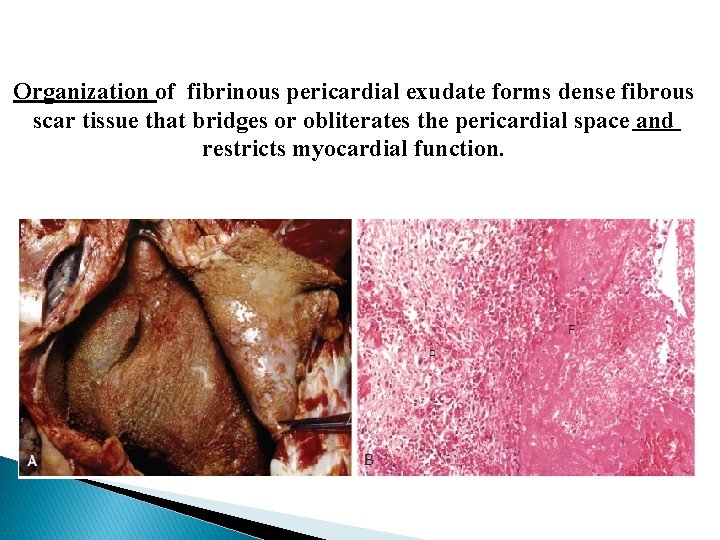 Organization of fibrinous pericardial exudate forms dense fibrous scar tissue that bridges or obliterates Organization of fibrinous pericardial exudate forms dense fibrous scar tissue that bridges or obliterates