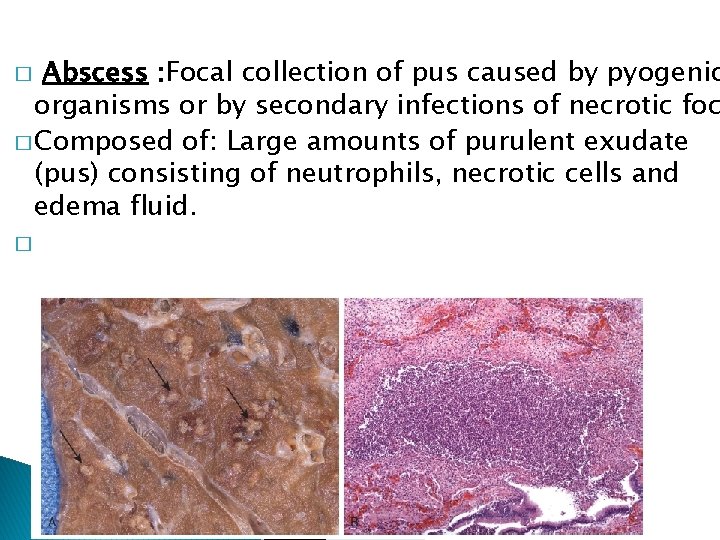 Abscess : Focal collection of pus caused by pyogenic organisms or by secondary infections Abscess : Focal collection of pus caused by pyogenic organisms or by secondary infections