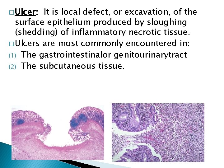 � Ulcer: It is local defect, or excavation, of the surface epithelium produced by � Ulcer: It is local defect, or excavation, of the surface epithelium produced by