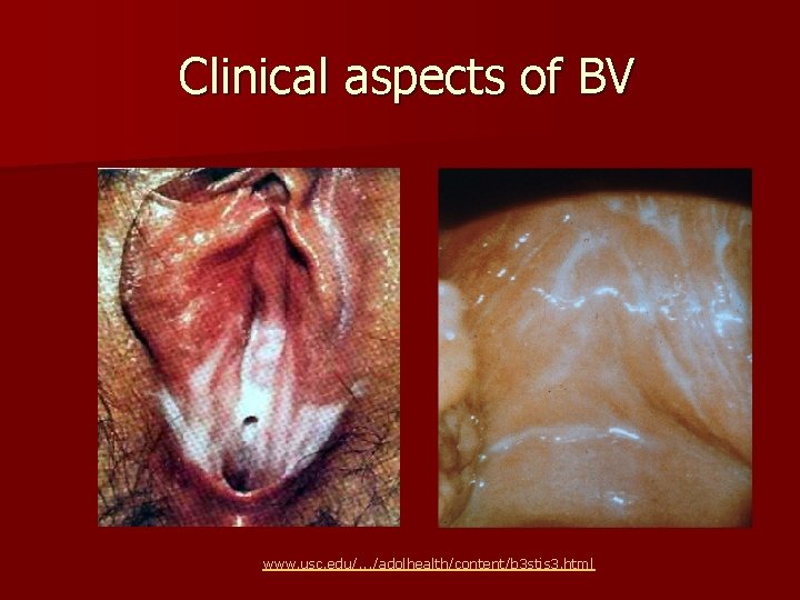 Clinical aspects of BV www. usc. edu/. . . /adolhealth/content/b 3 stis 3. html