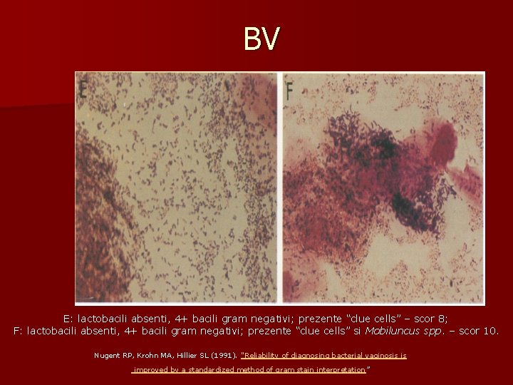 BV E: lactobacili absenti, 4+ bacili gram negativi; prezente “clue cells” – scor 8;