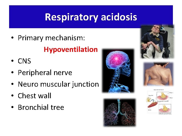 Respiratory acidosis • Primary mechanism: Hypoventilation • CNS • Peripheral nerve • Neuro muscular