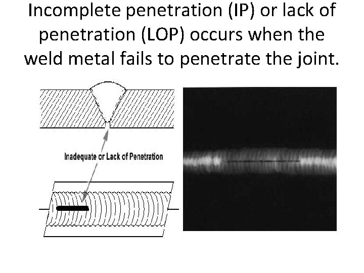 Incomplete penetration (IP) or lack of penetration (LOP) occurs when the weld metal fails