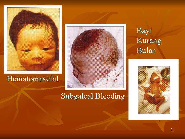 Bayi Kurang Bulan Hematomasefal Subgaleal Bleeding 21 