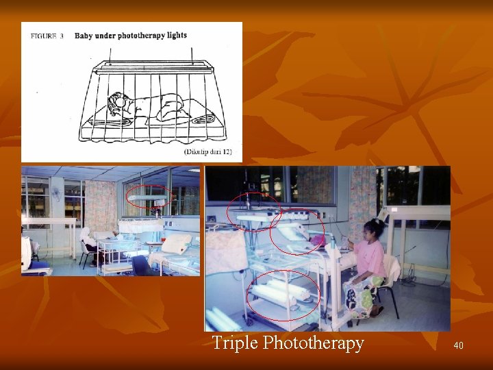 Triple Phototherapy 40 