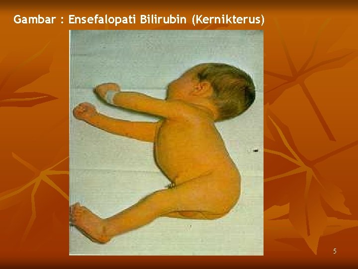 Gambar : Ensefalopati Bilirubin (Kernikterus) 5 