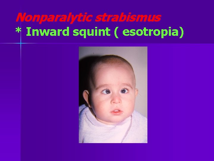 Nonparalytic strabismus * Inward squint ( esotropia) 