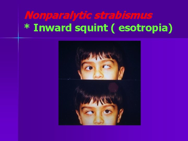 Nonparalytic strabismus * Inward squint ( esotropia) 