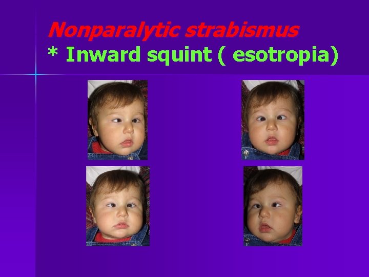 Nonparalytic strabismus * Inward squint ( esotropia) 