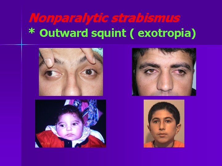 Nonparalytic strabismus * Outward squint ( exotropia) 