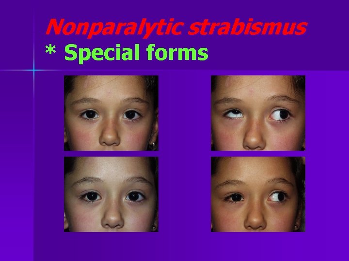 Nonparalytic strabismus * Special forms 