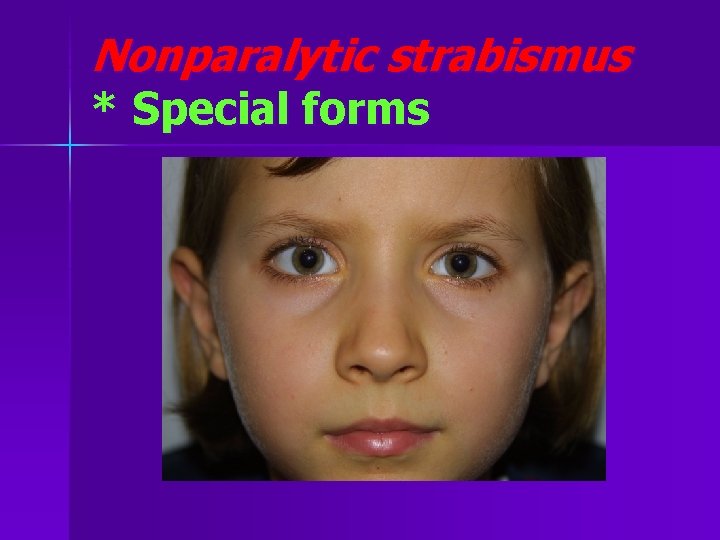 Nonparalytic strabismus * Special forms 