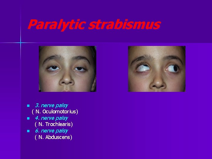 Paralytic strabismus n 3. nerve palsy ( N. Oculomotorius) n 4. nerve palsy (