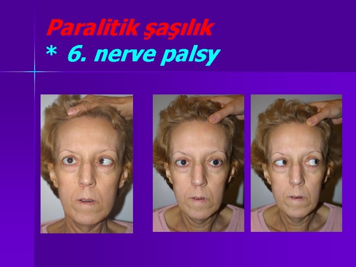 Paralitik şaşılık * 6. nerve palsy 