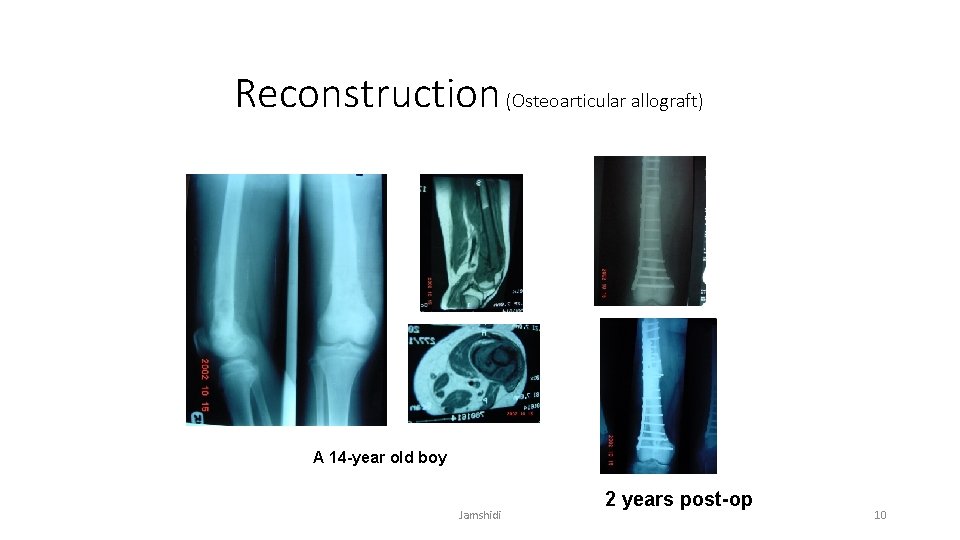 Reconstruction (Osteoarticular allograft) A 14 -year old boy Jamshidi 2 years post-op 10 