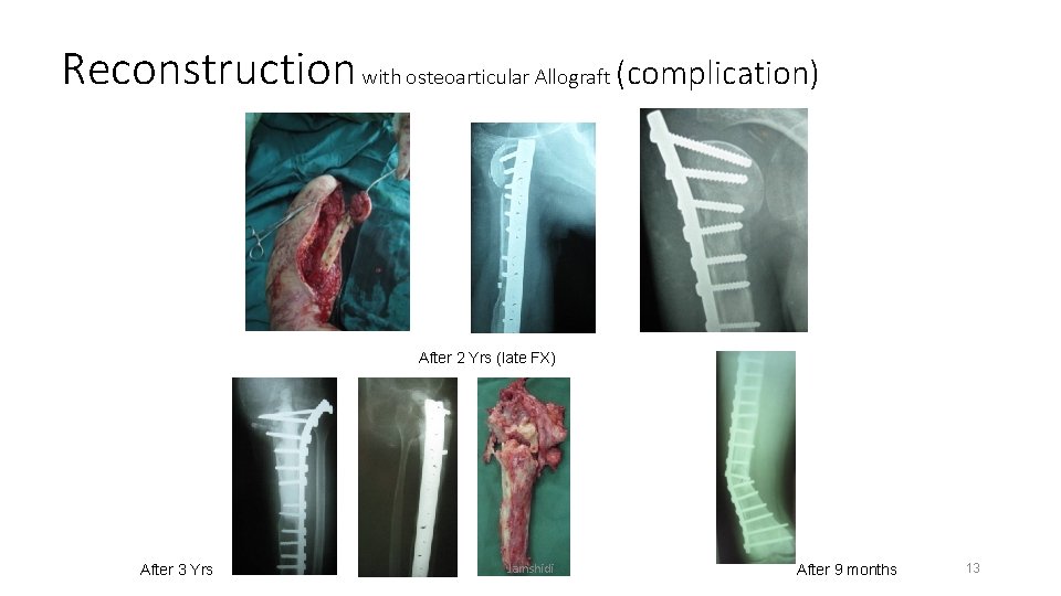 Reconstruction with osteoarticular Allograft (complication) After 2 Yrs (late FX) After 3 Yrs Jamshidi