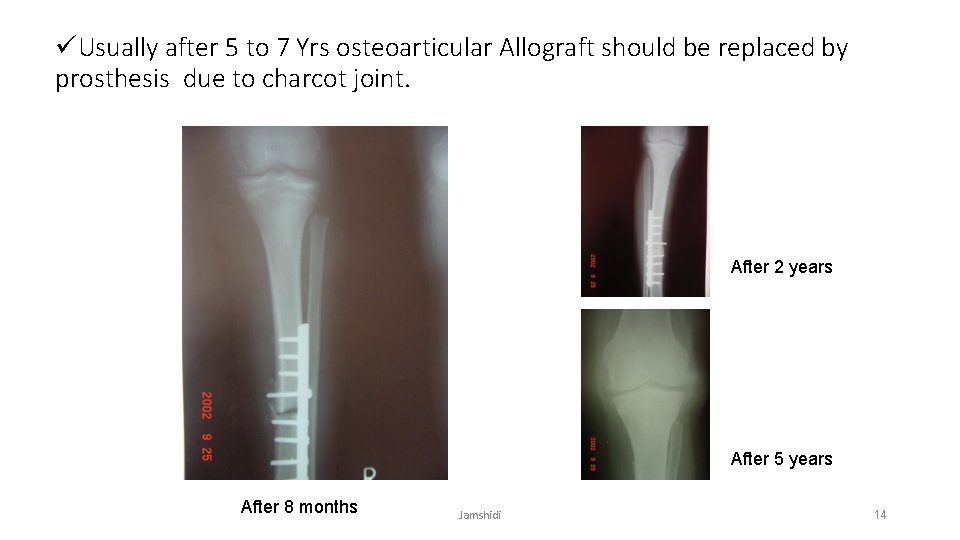 üUsually after 5 to 7 Yrs osteoarticular Allograft should be replaced by prosthesis due