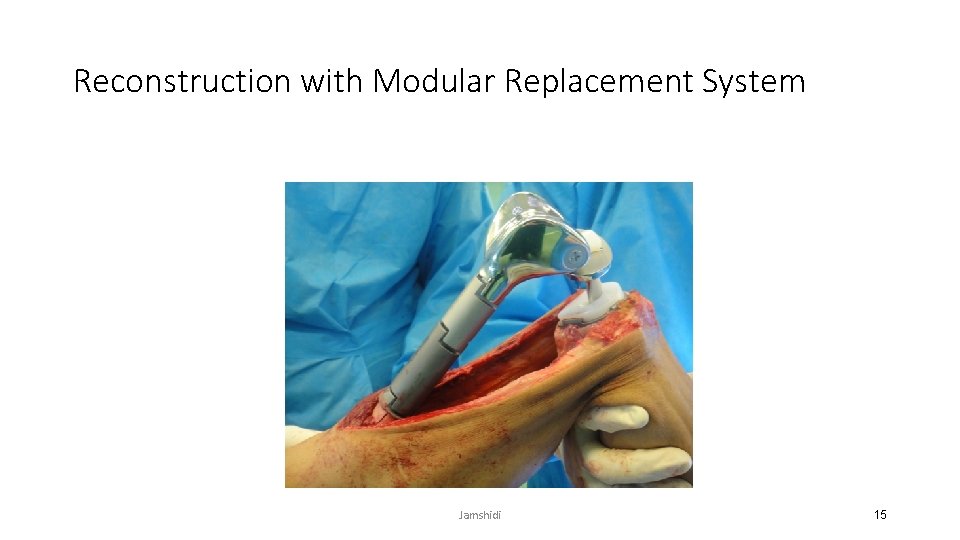 Reconstruction with Modular Replacement System Jamshidi 15 