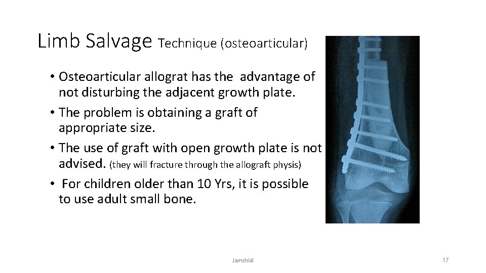 Limb Salvage Technique (osteoarticular) • Osteoarticular allograt has the advantage of not disturbing the