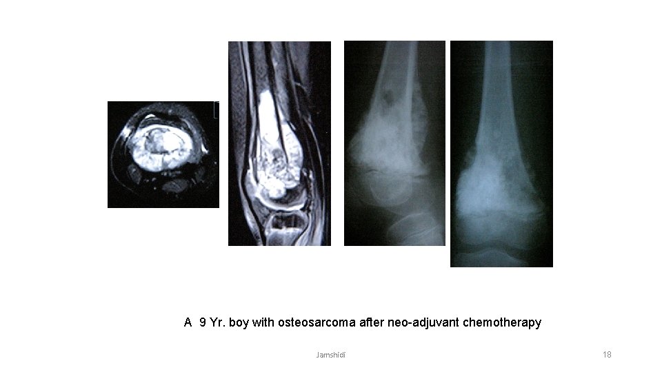 A 9 Yr. boy with osteosarcoma after neo-adjuvant chemotherapy Jamshidi 18 