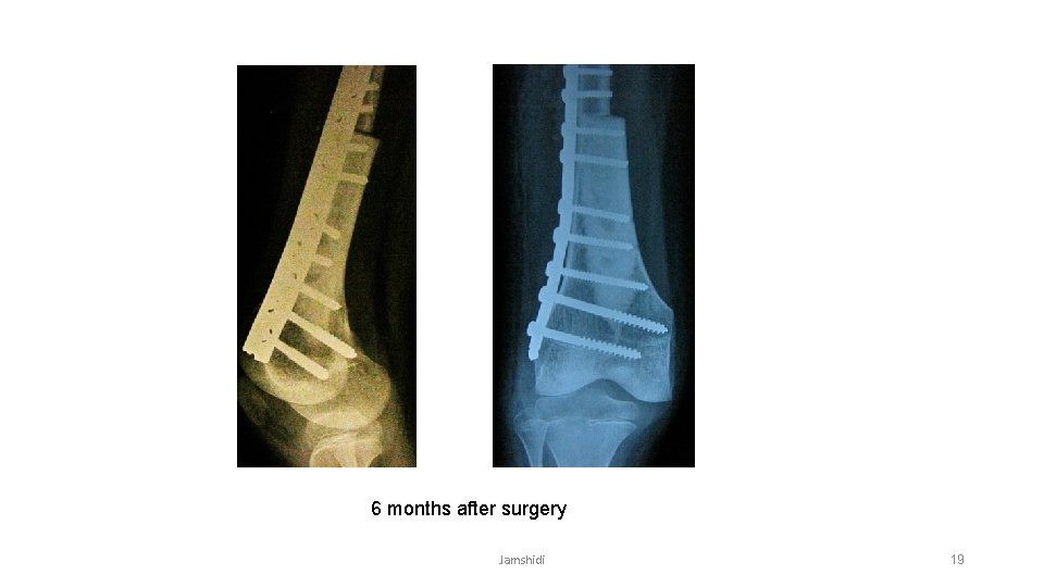 6 months after surgery Jamshidi 19 