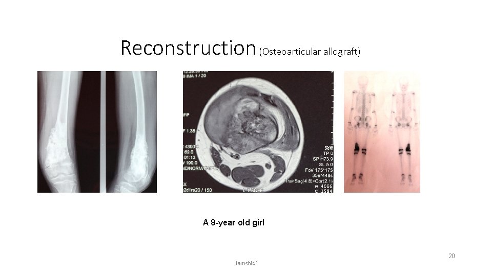 Reconstruction (Osteoarticular allograft) A 8 -year old girl Jamshidi 20 