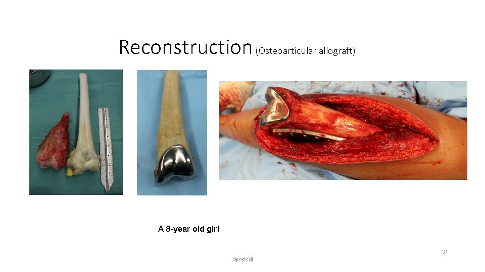 Reconstruction (Osteoarticular allograft) A 8 -year old girl Jamshidi 21 
