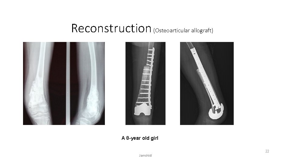 Reconstruction (Osteoarticular allograft) A 8 -year old girl Jamshidi 22 