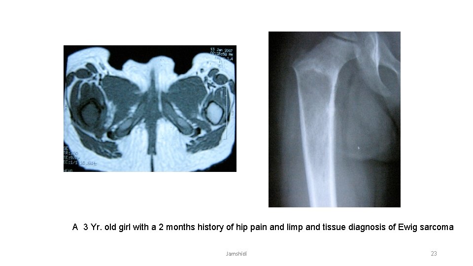 A 3 Yr. old girl with a 2 months history of hip pain and