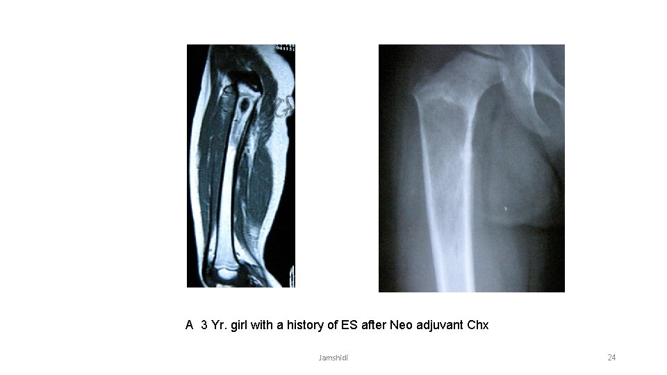 A 3 Yr. girl with a history of ES after Neo adjuvant Chx Jamshidi