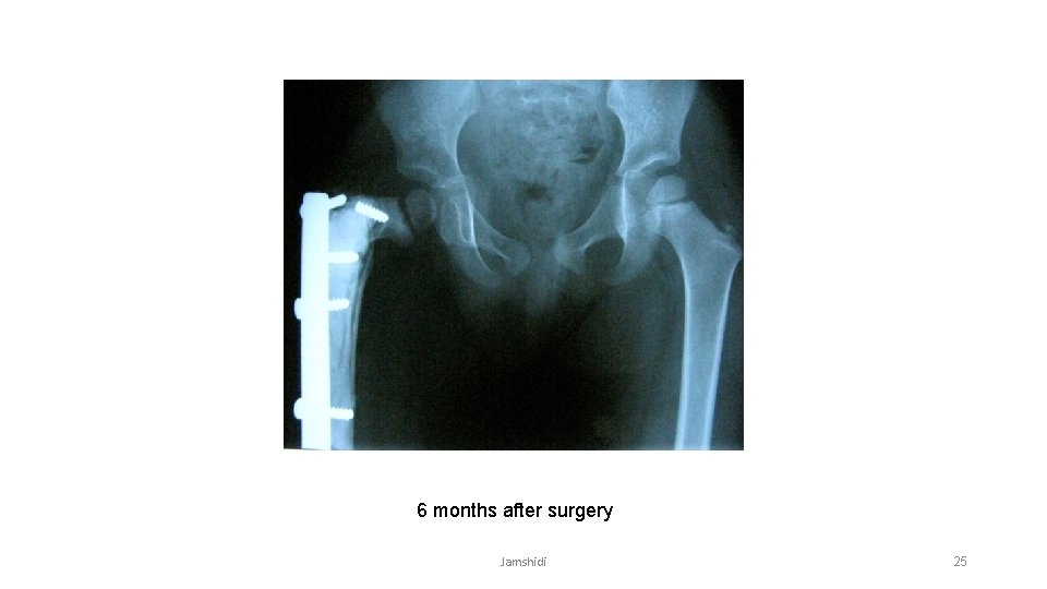 6 months after surgery Jamshidi 25 