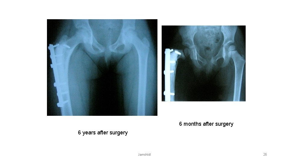 6 months after surgery 6 years after surgery Jamshidi 26 