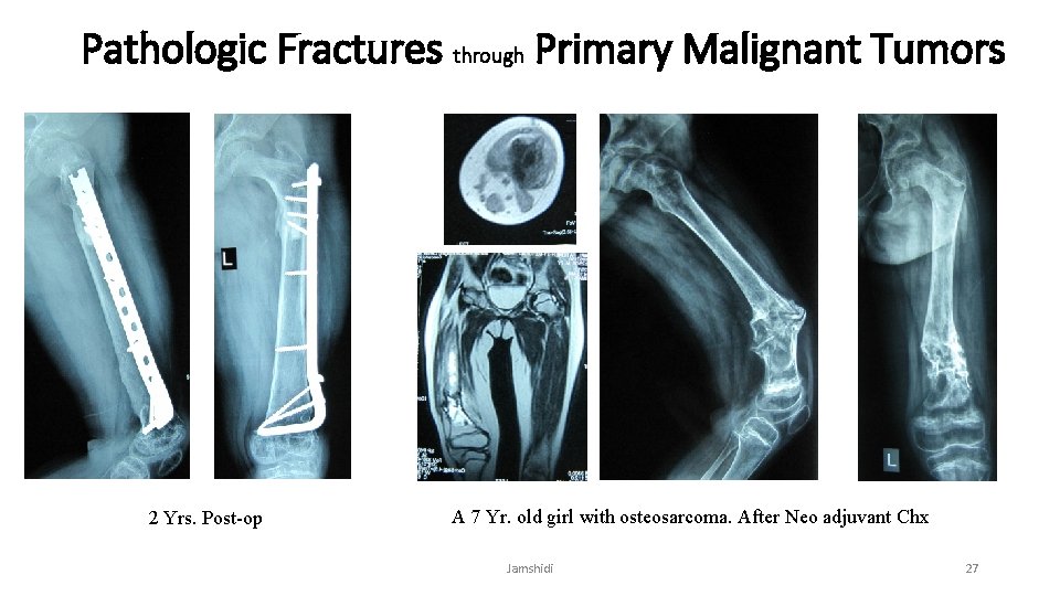 Pathologic Fractures through Primary Malignant Tumors 2 Yrs. Post-op A 7 Yr. old girl