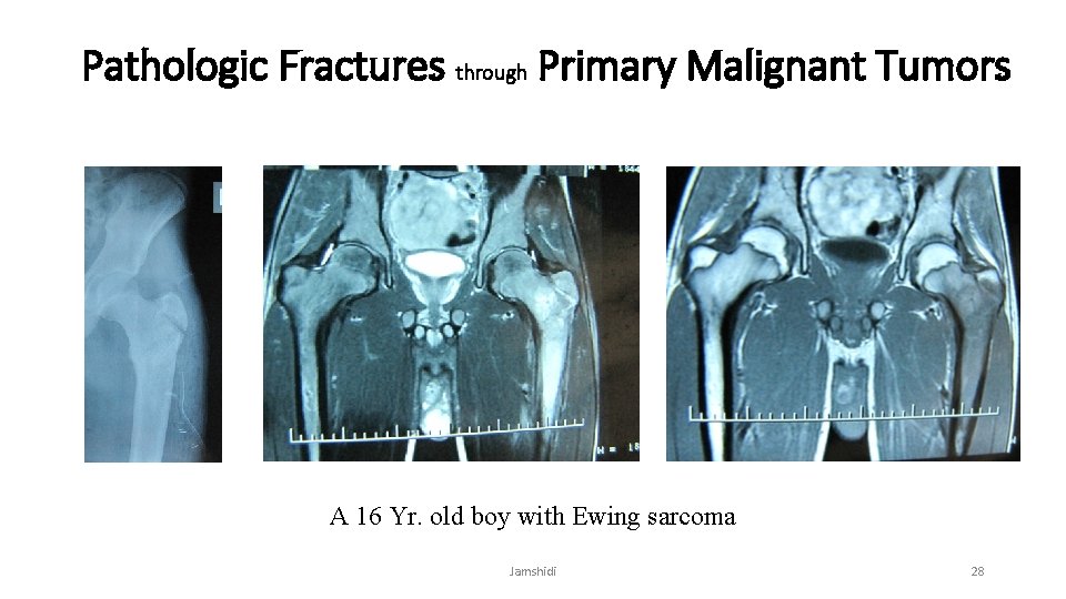Pathologic Fractures through Primary Malignant Tumors A 16 Yr. old boy with Ewing sarcoma
