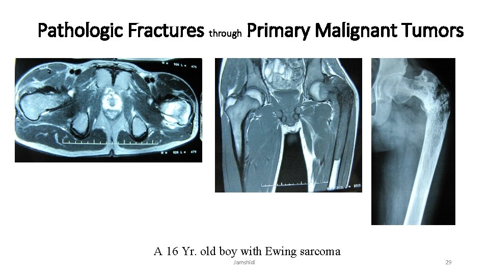 Pathologic Fractures through Primary Malignant Tumors A 16 Yr. old boy with Ewing sarcoma