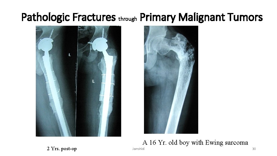 Pathologic Fractures through Primary Malignant Tumors 2 Yrs. post-op A 16 Yr. old boy
