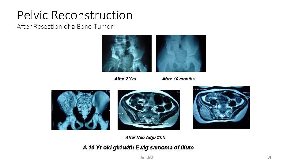 Pelvic Reconstruction After Resection of a Bone Tumor After 2 Yrs After 10 months
