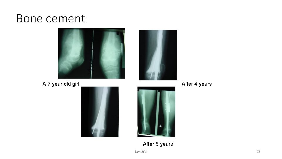 Bone cement A 7 year old girl After 4 years After 9 years Jamshidi