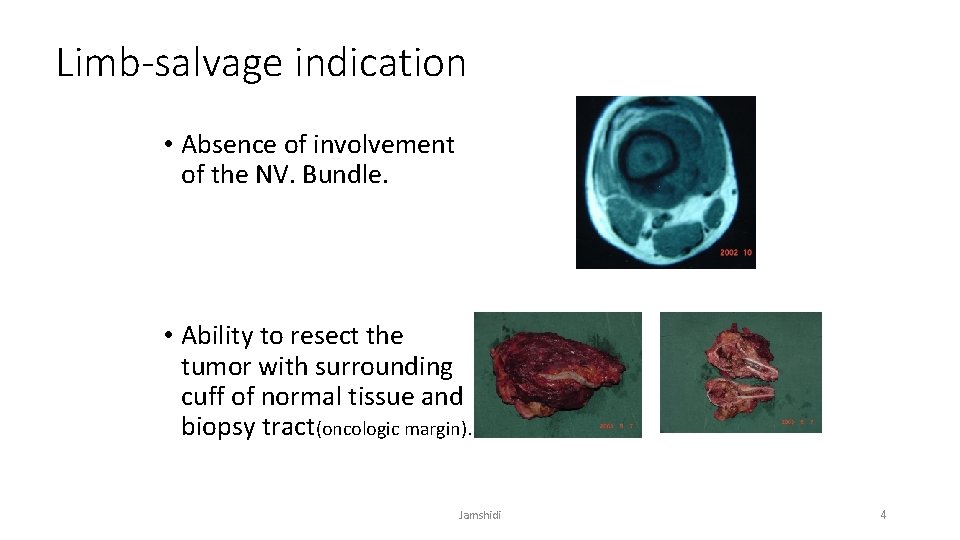 Limb-salvage indication • Absence of involvement of the NV. Bundle. • Ability to resect