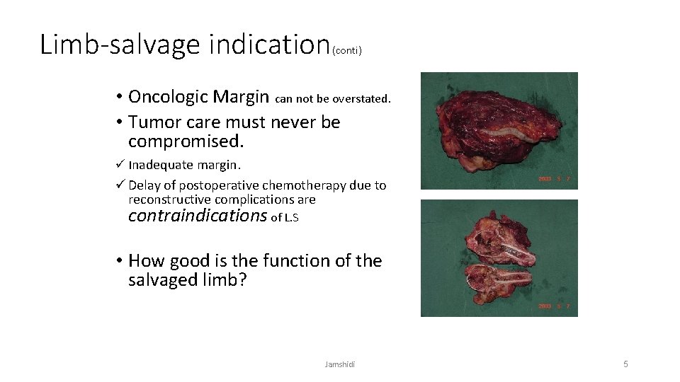 Limb-salvage indication (conti) • Oncologic Margin can not be overstated. • Tumor care must